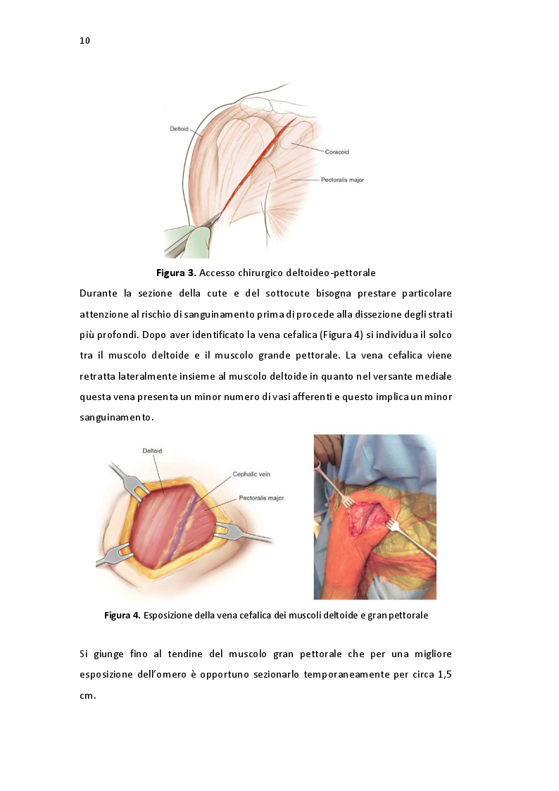 Anteprima della tesi: Protesi inversa di spalla in traumatologia indicazioni e risultati nell'esperienza della clinica ortopedica di Padova, Pagina 7