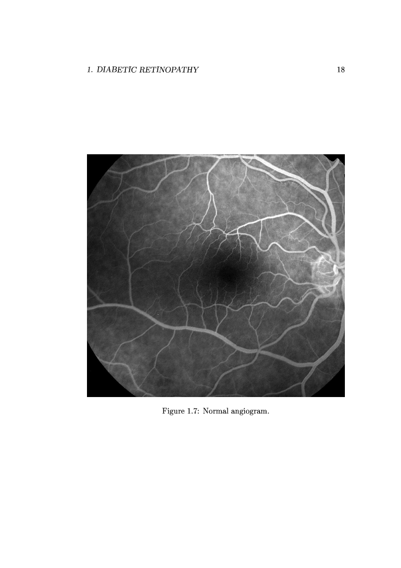 Anteprima della tesi: Computer Aided Diagnosis in Ocular Fundus Imaging, Pagina 14