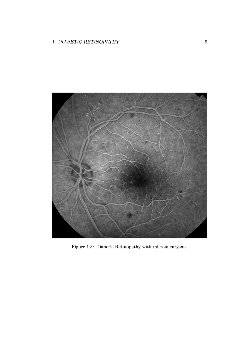 Anteprima della tesi: Computer Aided Diagnosis in Ocular Fundus Imaging, Pagina 5
