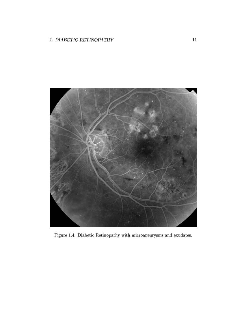 Anteprima della tesi: Computer Aided Diagnosis in Ocular Fundus Imaging, Pagina 7