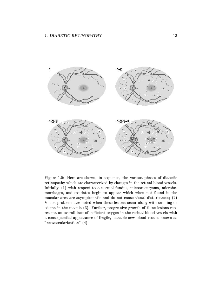 Anteprima della tesi: Computer Aided Diagnosis in Ocular Fundus Imaging, Pagina 9