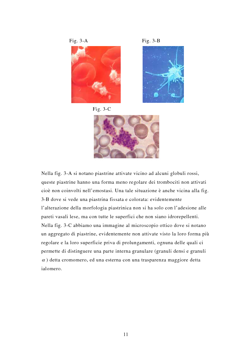 Anteprima della tesi: Porpora Trombocitopenica Idiopatica, Pagina 11